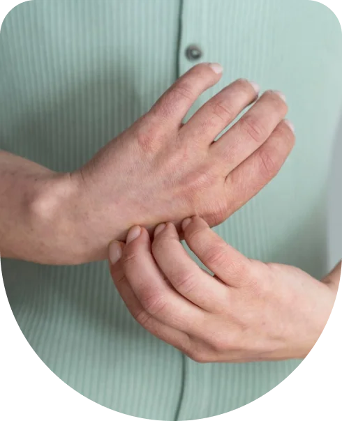 Reticular Veins in hand