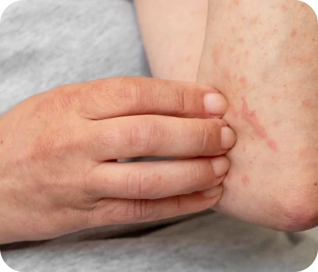 Telangiectatic veins