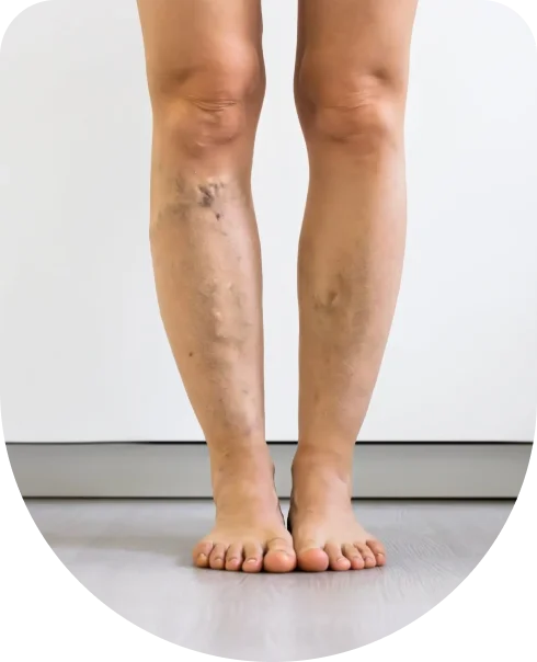 Both Legs skin ulcer