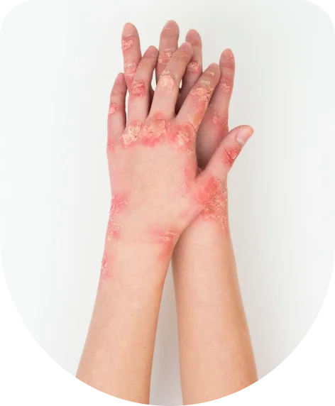 Stasis eczema