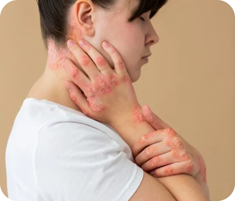 Chronic venous insufficiency dermatitis