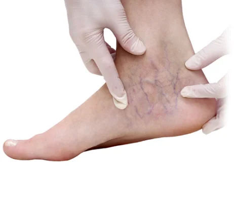 Venous telangiectasias around the ankle