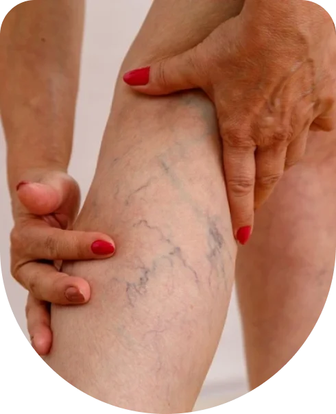 Peri-malleolar varicosities