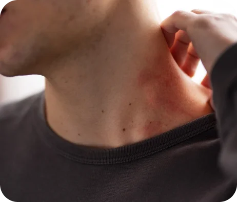 Sclerosing Panniculitis