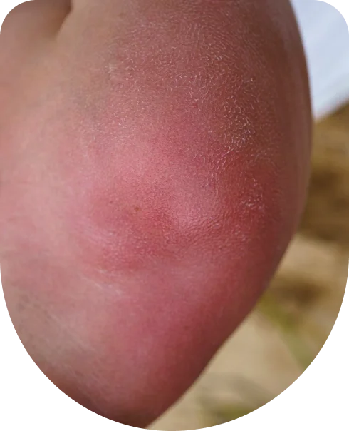 Venous Eczema