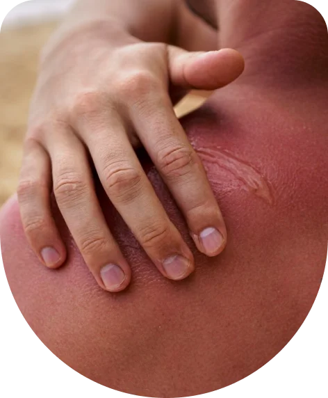 Chronic Lipodermatosclerosis