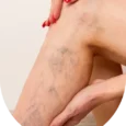 Vein Overgrowth Syndrome