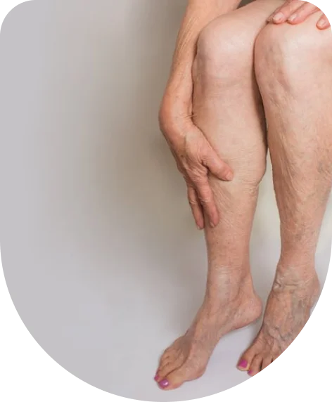 Hemangiectatic Hypertrophy