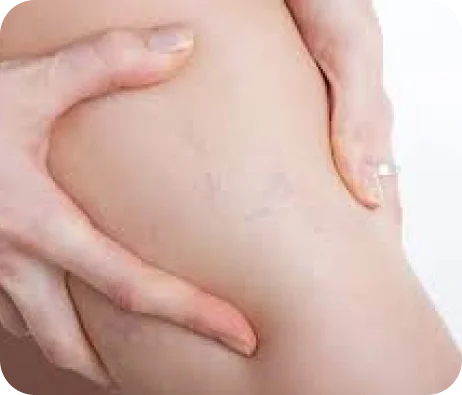 Angioosteohypertrophy Syndrome