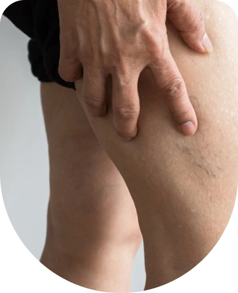 Blood Clot in Deep Veins