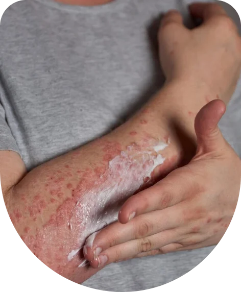 Putting Cream in a hand full of rashes