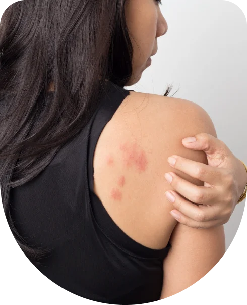 Back dermatitis