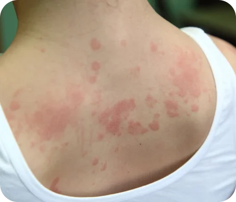 Skin irritation on back