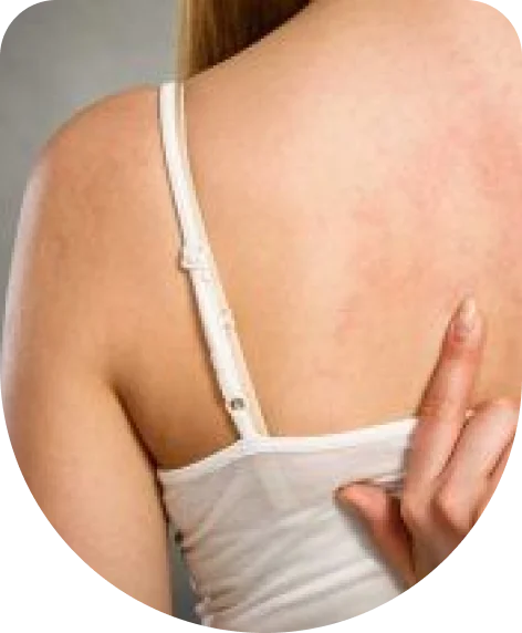 Upper Back Rashes