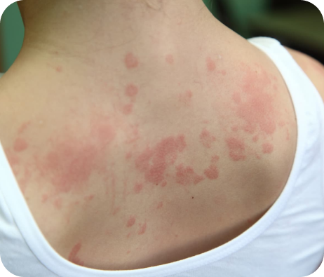 Back of the shoulder rashes