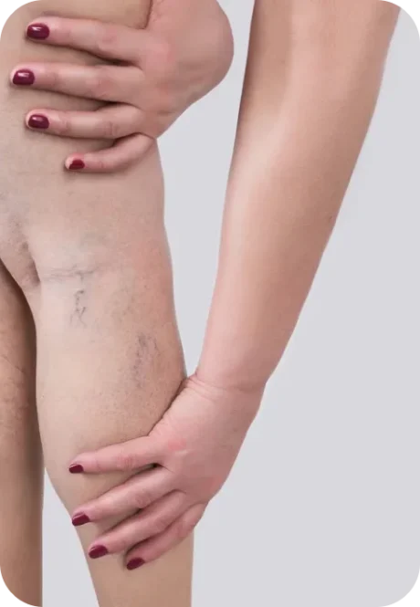Broken capillaries