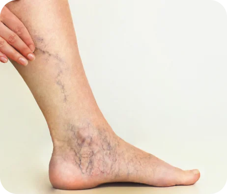 Varicose Veins Oak Brook