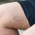 Swollen veins