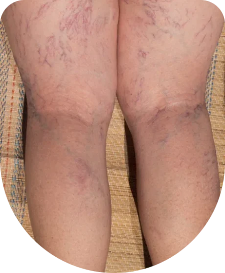 Best Treatments for Varicose Vein Relief and Healing 2 Best Treatments for Varicose Vein Relief and Healing