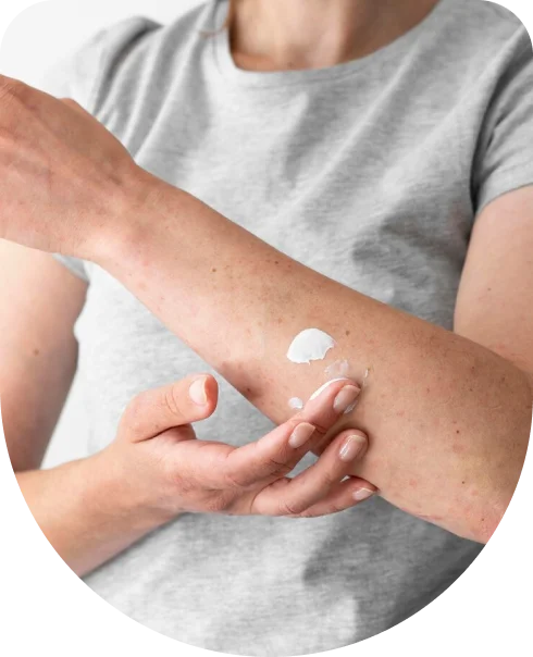 Putting ointment in the skin