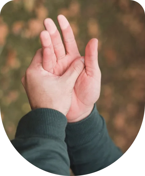 Thromboangiitis obliterans