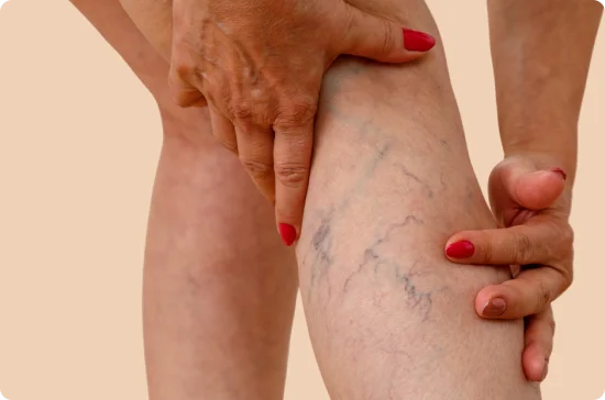 Varicose veins in the calf