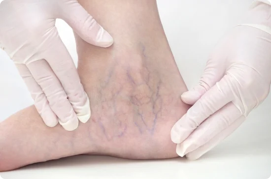 Varicose veins in the ankle