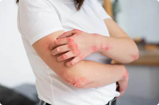 Arms and Elbow on rashes
