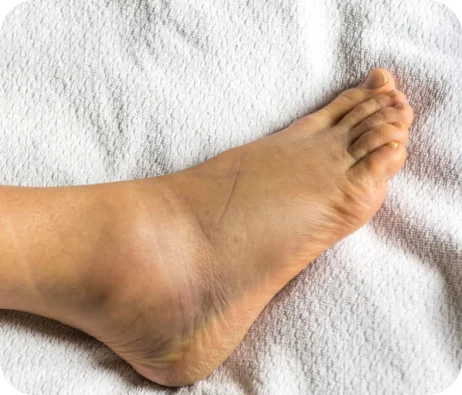 Foot venous insufficiency