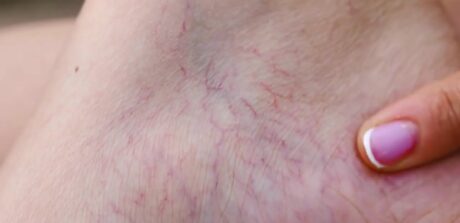 Small Spider Veins