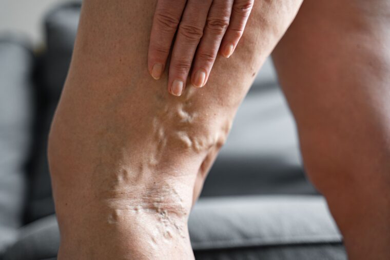 Vein Specialist