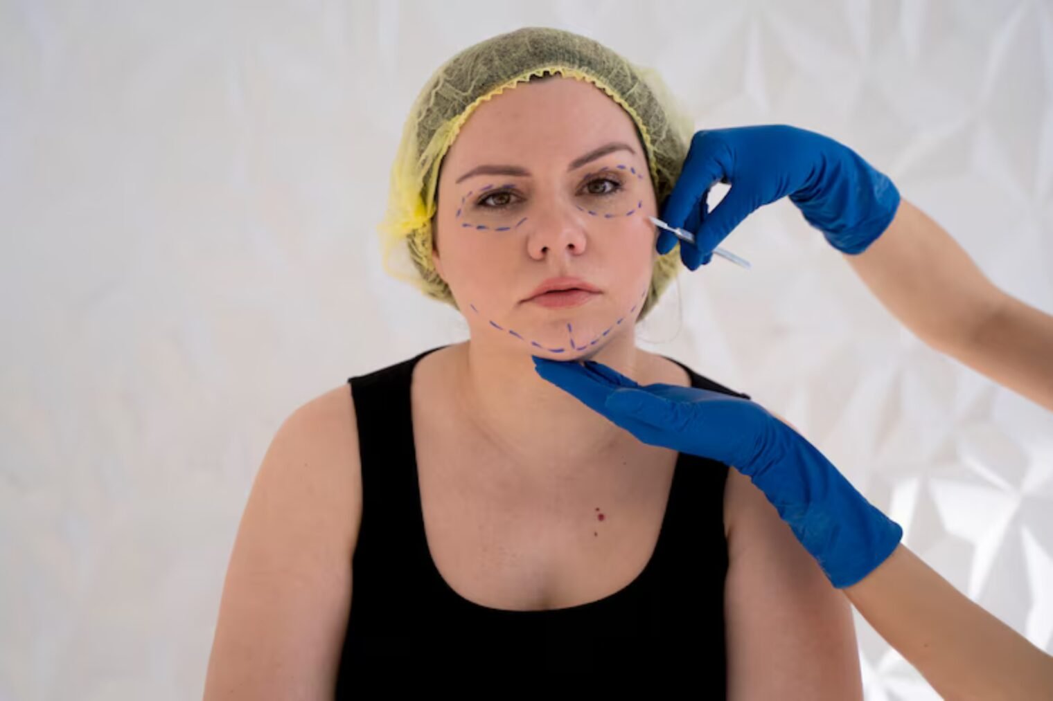 Can You Really Lift Skin with PDO Threads? 1 PDO Threads make face shape perfect