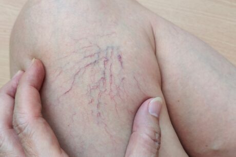Spider Veins