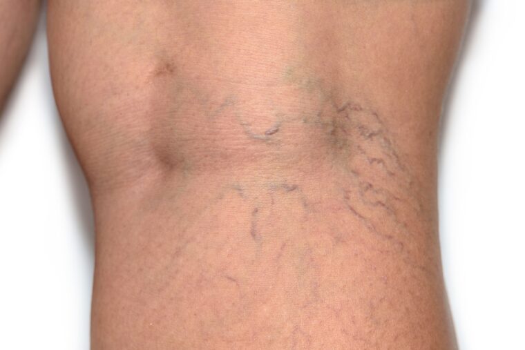 Small Spider Veins