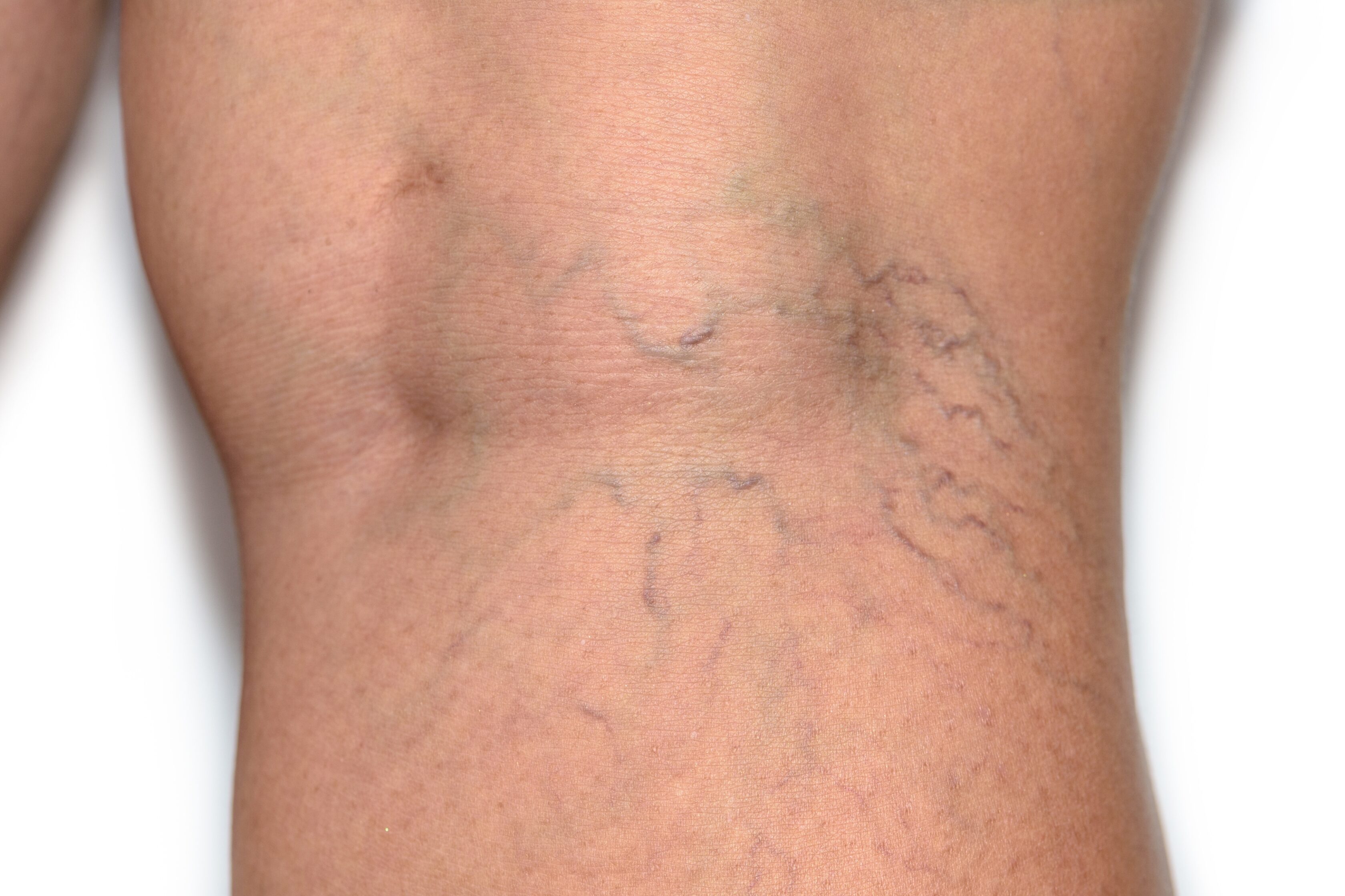 Small Spider Veins
