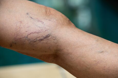 legs with Varicose Veins