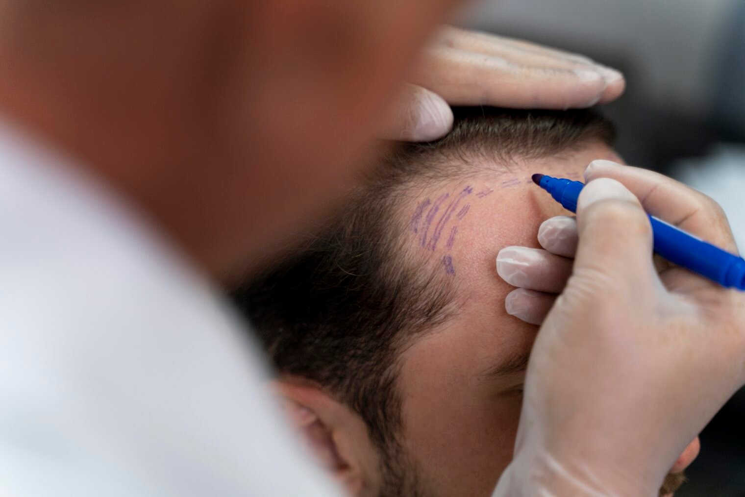 Hair Transplant Oak Brook