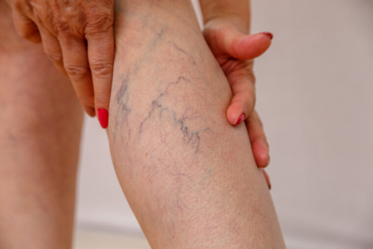 spider veins on legs