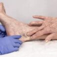 spider vein removal