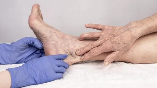 spider vein removal