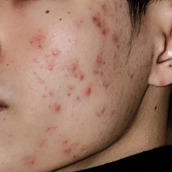 acne scars