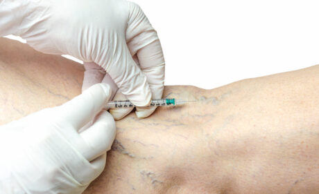 Spider Vein Treatment