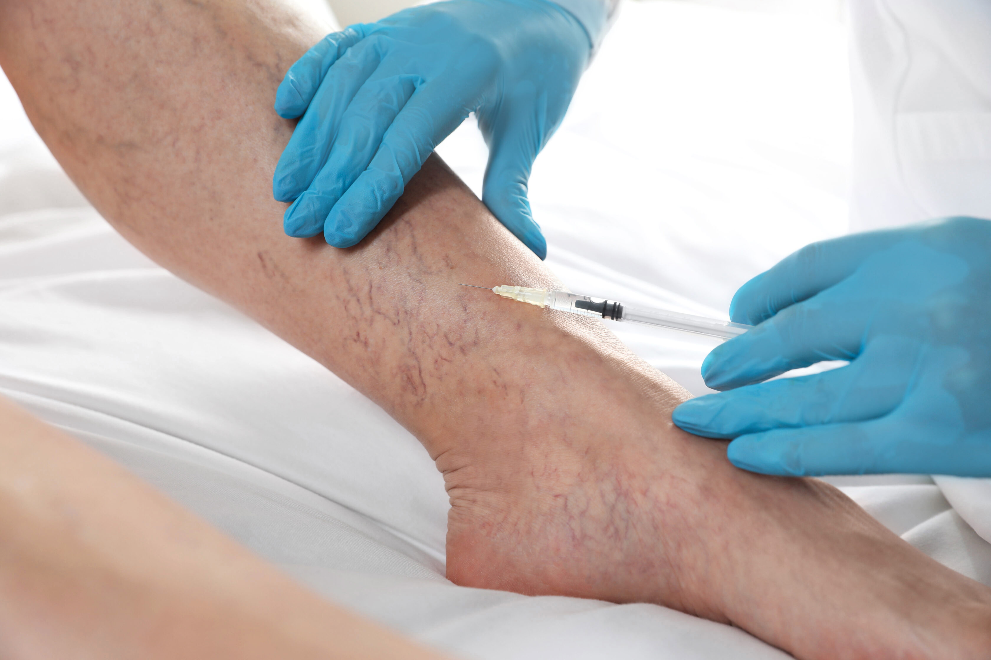 Spider Vein Treatment