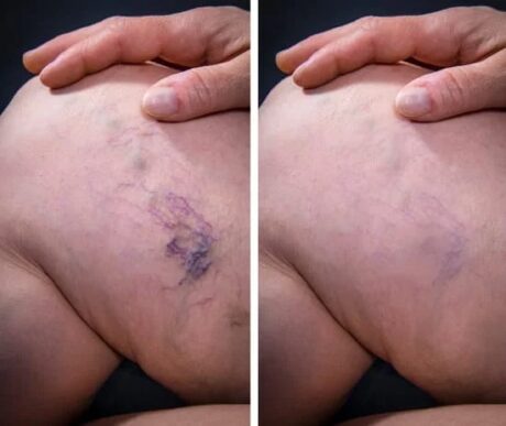 Sclerotherapy