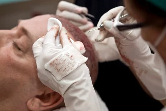 local hair transplant surgeons