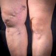 Sclerotherapy