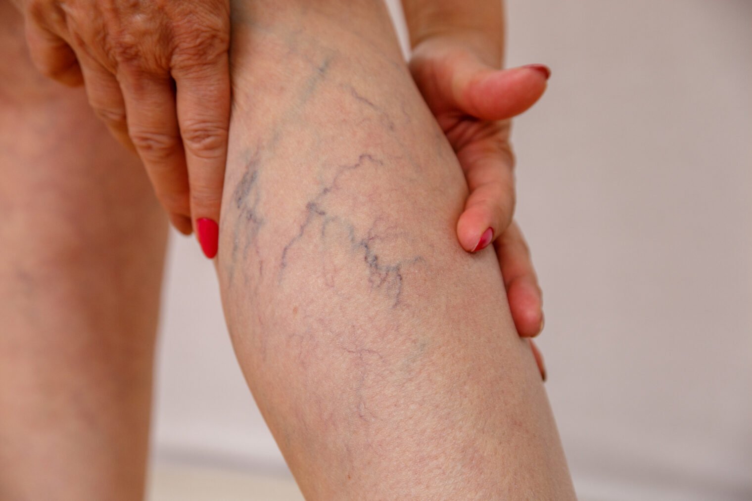 Close-up of spider veins and early-stage varicose veins on a female patient's calf during a consultation at a vein clinic in Chicago