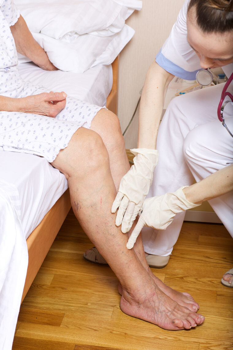 Varicose Veins