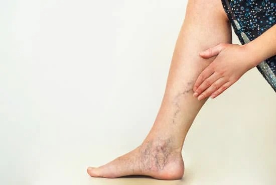 varicose veins