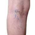 Endovenous Laser Treatment Best Veins Specialist for Same Day Consultation Help